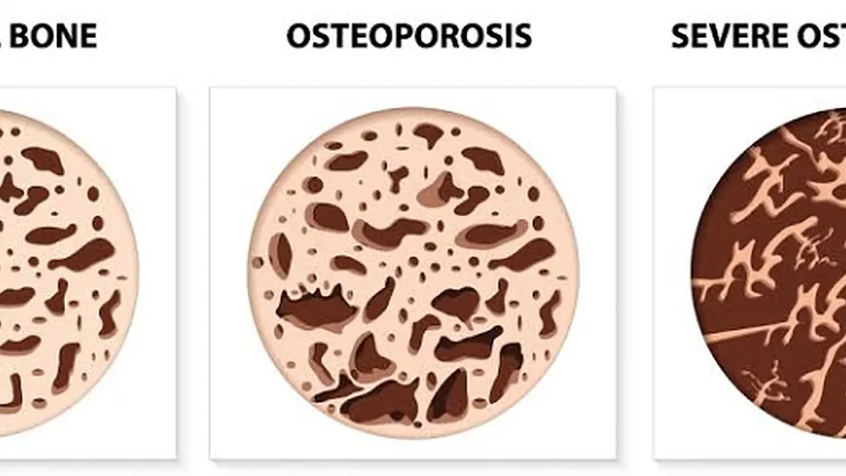 Love your bones and protect your future Image