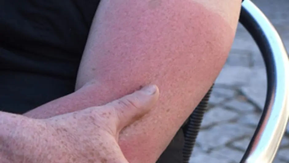 IFA joins Cancer Society to remind farmers of sun risks Image