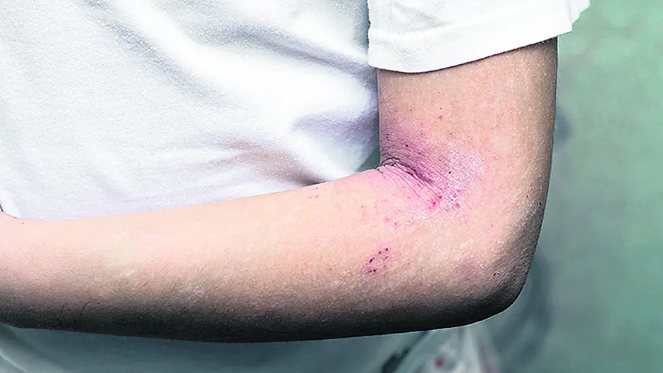 HEALTH: Scratching the surface of eczema problems Image
