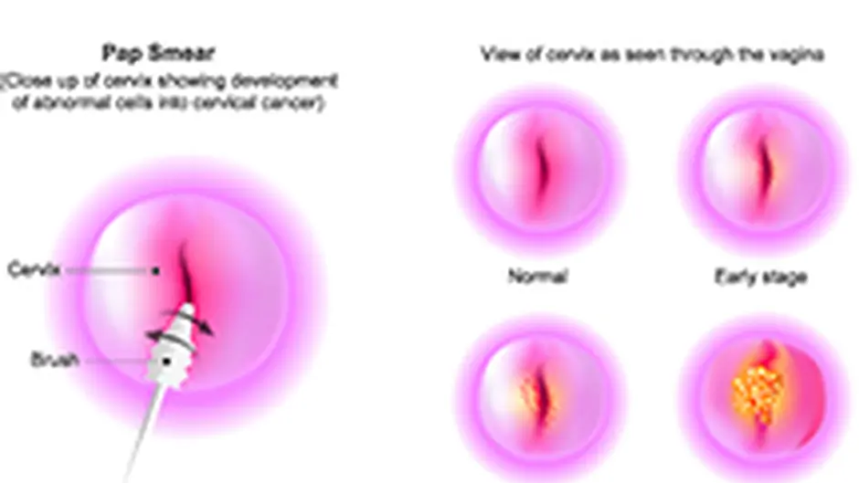 Delay of 8 months for smear test results here Image