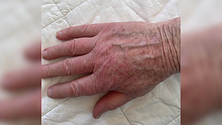 Skin breakout claim over water Image