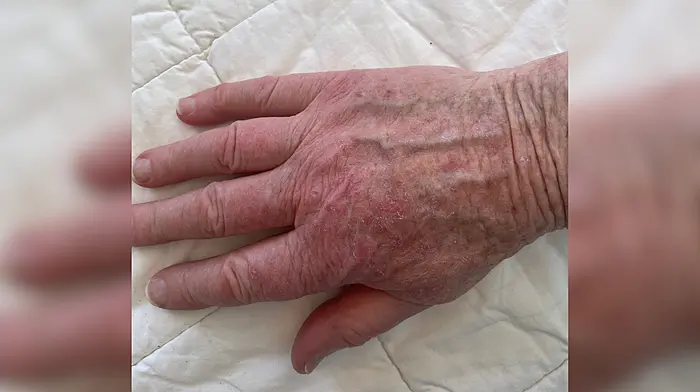 Skin breakout claim over water Image