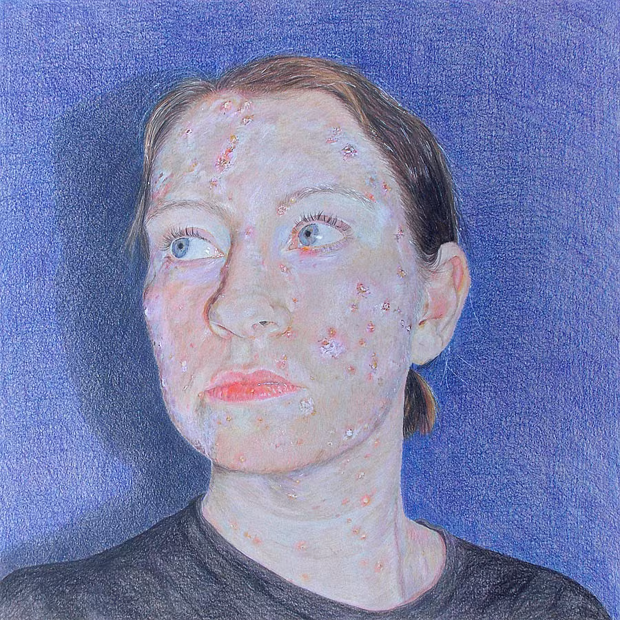 Emily-McGardle,-'The-Pox'