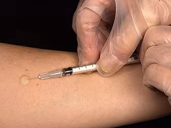 TB cases increase