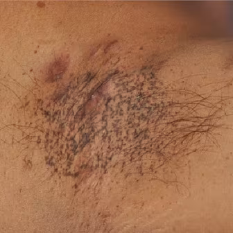 Living with Hidradenitis Suppu...