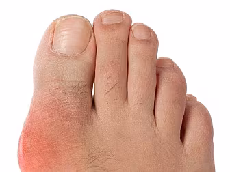 How To Treat And Prevent Gout