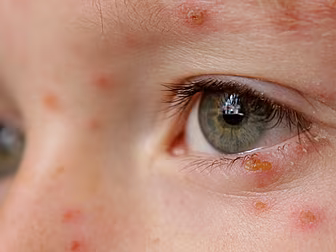 Classroom Illnesses Parents Sh...
