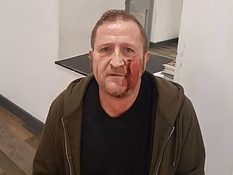 Man Suffers Facial Injuries In...