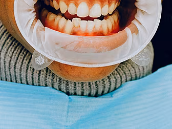 What Are The Symptoms Of Mouth...