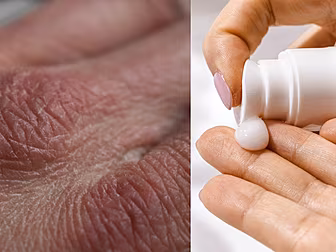 How To Manage Dry Skin This Wi...