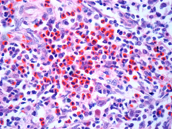Dealing With Hodgkins Lymphoma