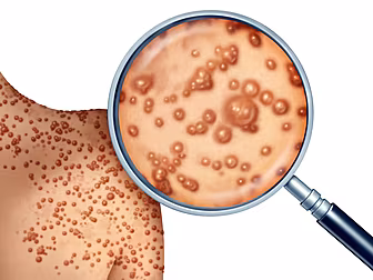 Monkeypox Outbreak Is A 'Scien...