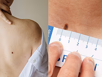 The ABCDE To Minding Your Skin...