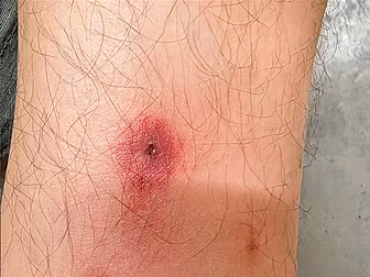 THIS Is The Most Painful Bite...